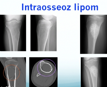 tibia intra osseoz lipoma 