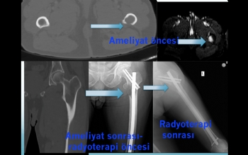 femur proksimal metastaz fiksasyon ve radyoterapi ile tümör kontrolü 