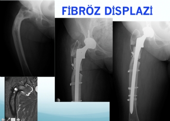 FEMUR FİBRÖZ DİSPLAZİ DEFORMİTE DÜZLTİMİ, KALÇA PROTEZ UYGULAMASI