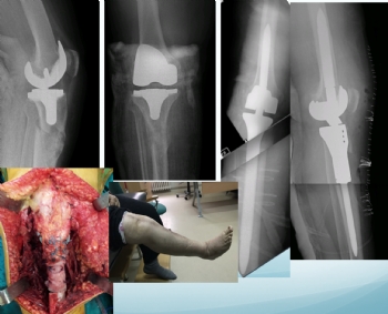 tibia proksimal metastaz modüler protez ve prolen mesh ile ekstansör mekanizma tamiri