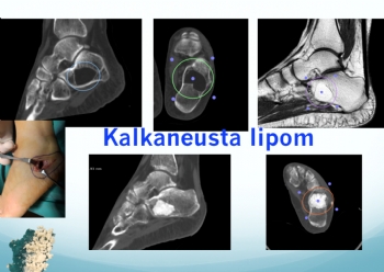 intraosseoz lipom (kalkaneus)