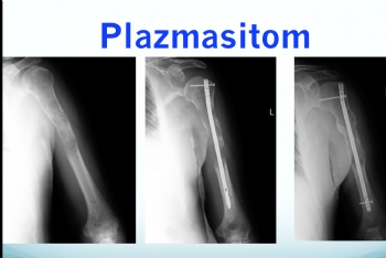 humerus plazmastom intramedüller çivi 