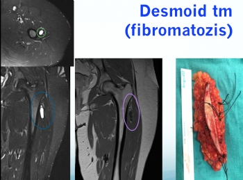 kalça desmoid tumor, fibromatozis, 