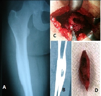 osteoid osteoma 