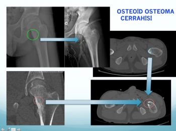 femur boyunda osteoid osteoma , collum femoris osteoid osteoma