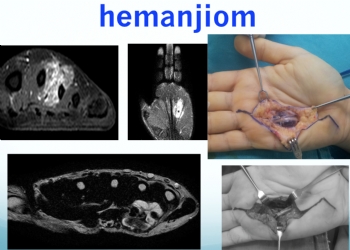 hemanjiom, hemangioma