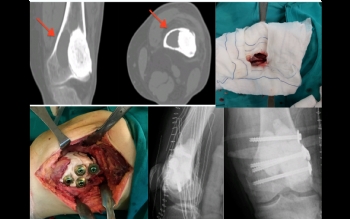 femur distal dev hücreli kemik tümör nüks revizyonu 