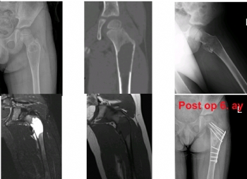 femur basit kemik kisti