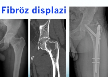 femur fibroz displazi , intramedüller çivi, femur , fibrous dysplasia and intramedullary nailing 