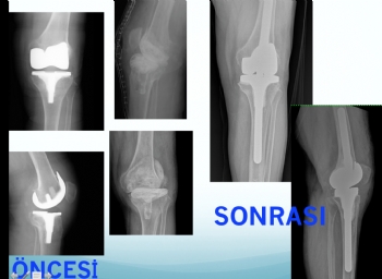 diz protezi  iki aşamalı revizyon (septik-enfeksiyona bağlı gevşeme )