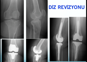 DİZ PROTEZİ, REVİZYON CERRAHİSİ