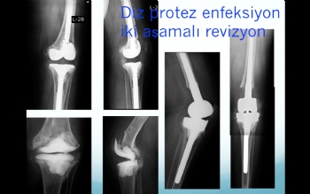 diz protezi  iki aşamalı revizyon (septik-enfeksiyona bağlı gevşeme )