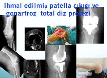 eski patella çıkığı zemininde gonartroz total diz protezi 