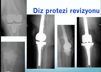 Diz Protezi Revizyonu