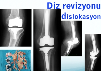 diz protezi revizyonu, dislokasyonu- redüksiyon