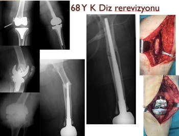 Diz Protezi Revizyonu