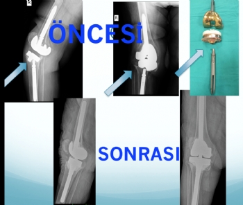 diz protezi tek aşamalı revizyon (implant yetmezliğine bağlı problemler )