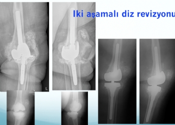 Diz Protezi Revizyonu