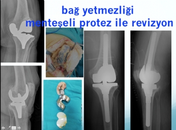 kalça protezi tek aşamalı revizyon (bağ yetmezliğine bağlı problemler )
