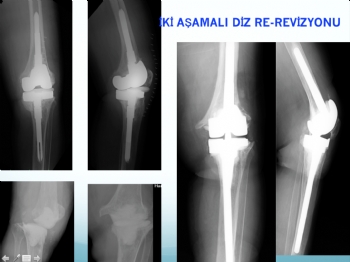 diz protezi  iki aşamalı revizyon (septik-enfeksiyona bağlı gevşeme )