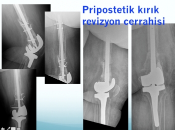 Diz Protezi Revizyonu