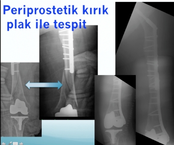 periprostetik femur kıırığı 