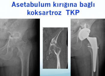 asetabulum kırığına bağlı koksartroz total kalça protezi 