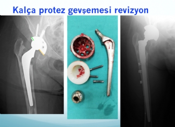 kalça protezi tek aşamalı revizyon (implant yetmezliğine bağlı problemler )