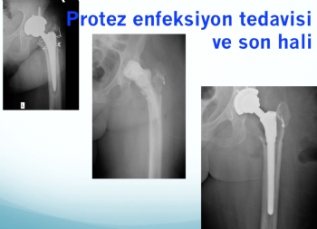 kalça protez revizyonu (iki aşamalı revizyon)