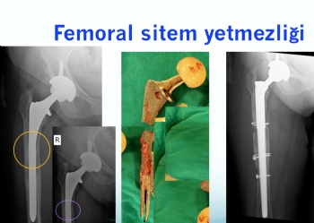 kalça protezi femoral sitem kırılması ve revizyonu 
