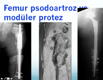femur psodoartroz modüler protez revizyon