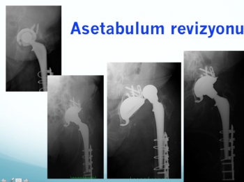 asetabulum revizyonu