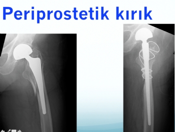 KALÇA PROTEZ ÇEVRESİ KIRIK CERRAHİSİ, REVİZYONU