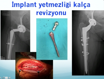 kalça protezi tek aşamalı revizyon (implant yetmezliğine bağlı problemler )