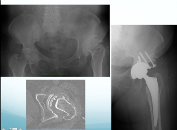 total kaçla protezi, total hip arthroplasty 