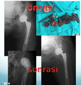 Kalça Protezi Revizyon Ameliyatı