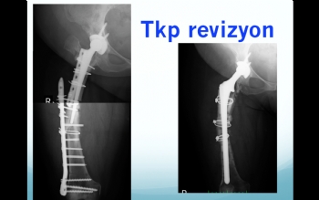 Kalça Protezi Revizyon Ameliyatı