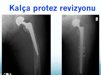 total kalça protezi revizyonu