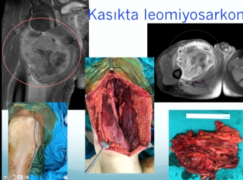 kasıkta maling yumuşak doku tümörü (leomiyosarkom)