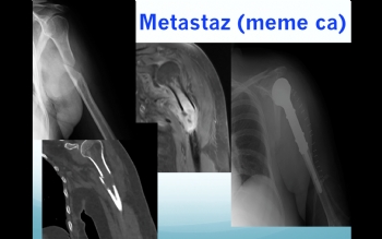 humerus proksimal metastaz da omuz protezi
