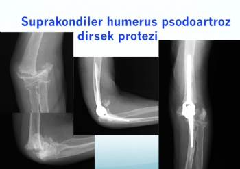 humerus alt uç kaynamam - psodoartrozda dirsek protezi