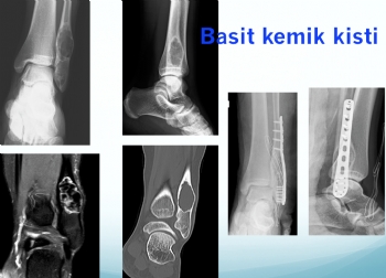 fibula basit kemik kist, simple bone cyst 