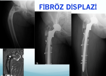 Fibröz Displazi