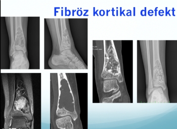 tibia distal fibröz kortikal defekt , küretaj ve kemik grefti ile rekonstrüksiyon