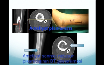 Osteoid osteomanın cerrahi olarak çıkarılması 