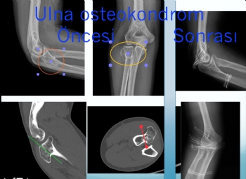  ulna proksimal (dirsek) osteokondroma 