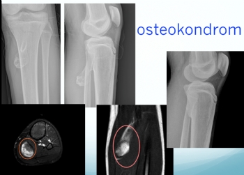 tibia posterior osteokondroma 