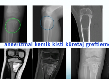 tibia proksimal anevrizmal kemik kisti