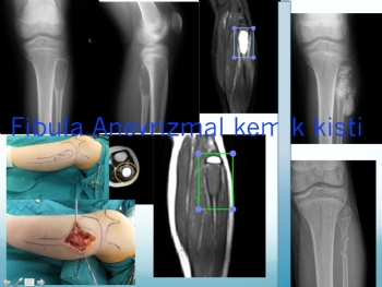 fibula anevrizmal kemik kisti