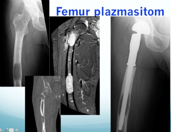 Multiple Miyelom / Plazmastom